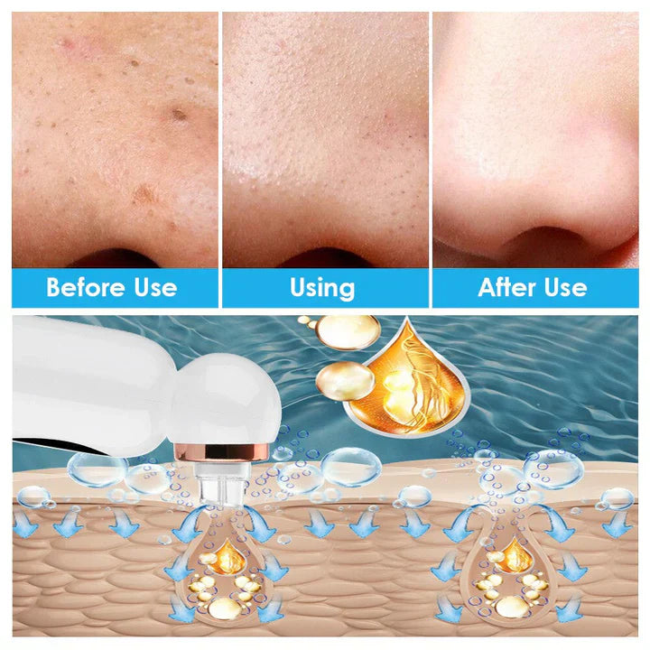 Blackhead Remover and Hydrodermabrasion Device-Homelova